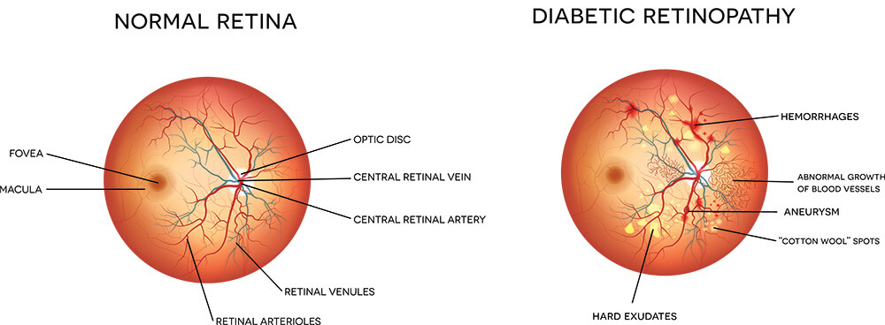 Chart Illustrating How Diabetic Retinopathy Affects an Eye