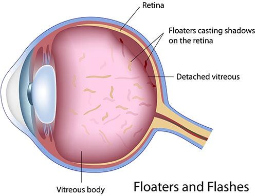 Chart Illustrating What Causes Floaters and Flashes in an Eye