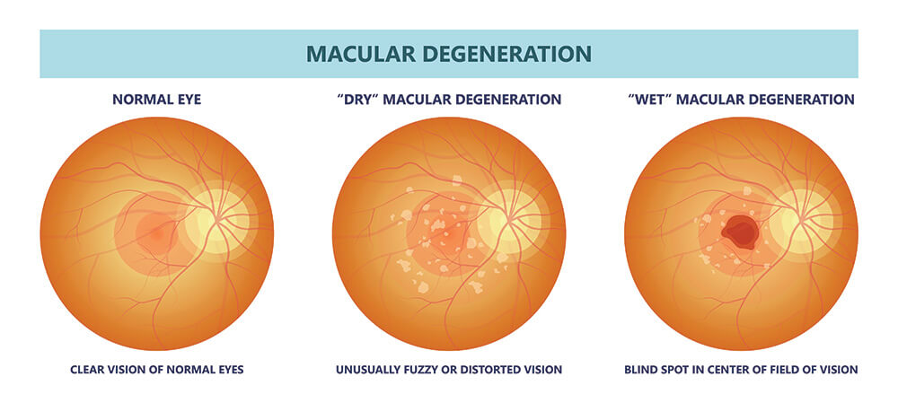 Chart Illustrating How Macular Degeneration Affects an Eye