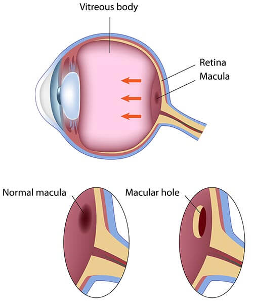 Chart Illustrating a Normal Macula Compared to a Macular Hole