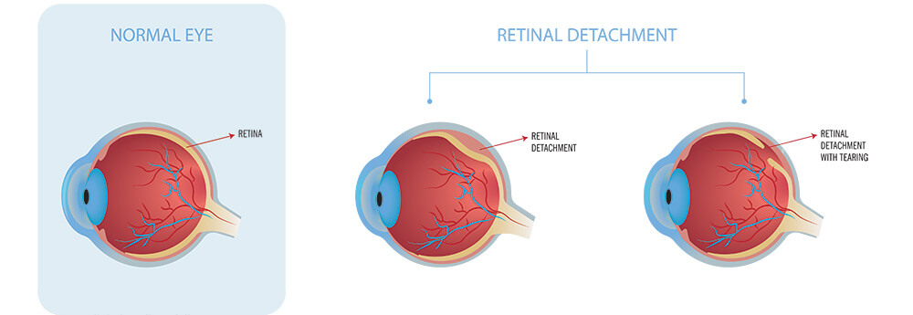 Chart Illustrating a Retinal Detachment