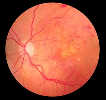 Retinal Vein Occlusion